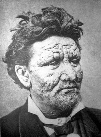  En 24 år gammel spedalsk nordmann fra ca. 1886